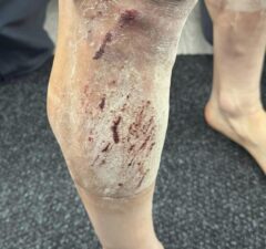 poszarpana noga Michała Kwiatkowskiego
